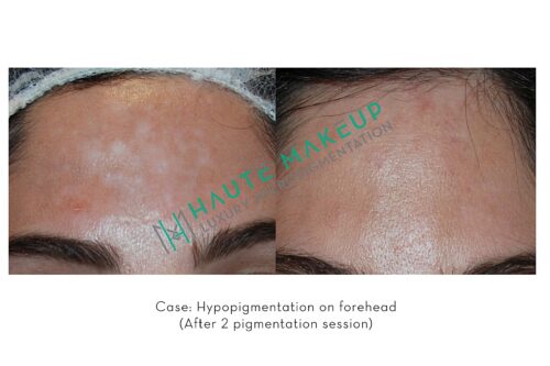 haute-medi-camouflage-pigmentation-case1-1800x1200