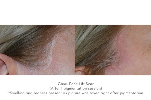 Face lift Scar