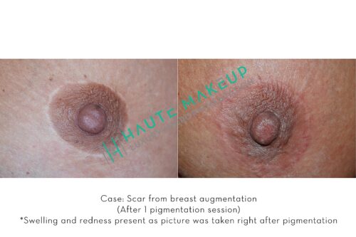 Scar from breast augmentation